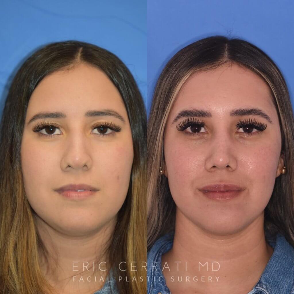 Female patient before and after rhinoplasty
