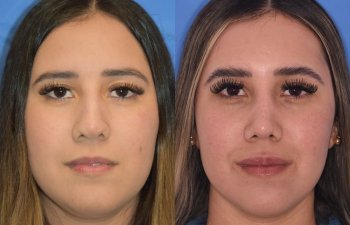 Female patient before and after rhinoplasty