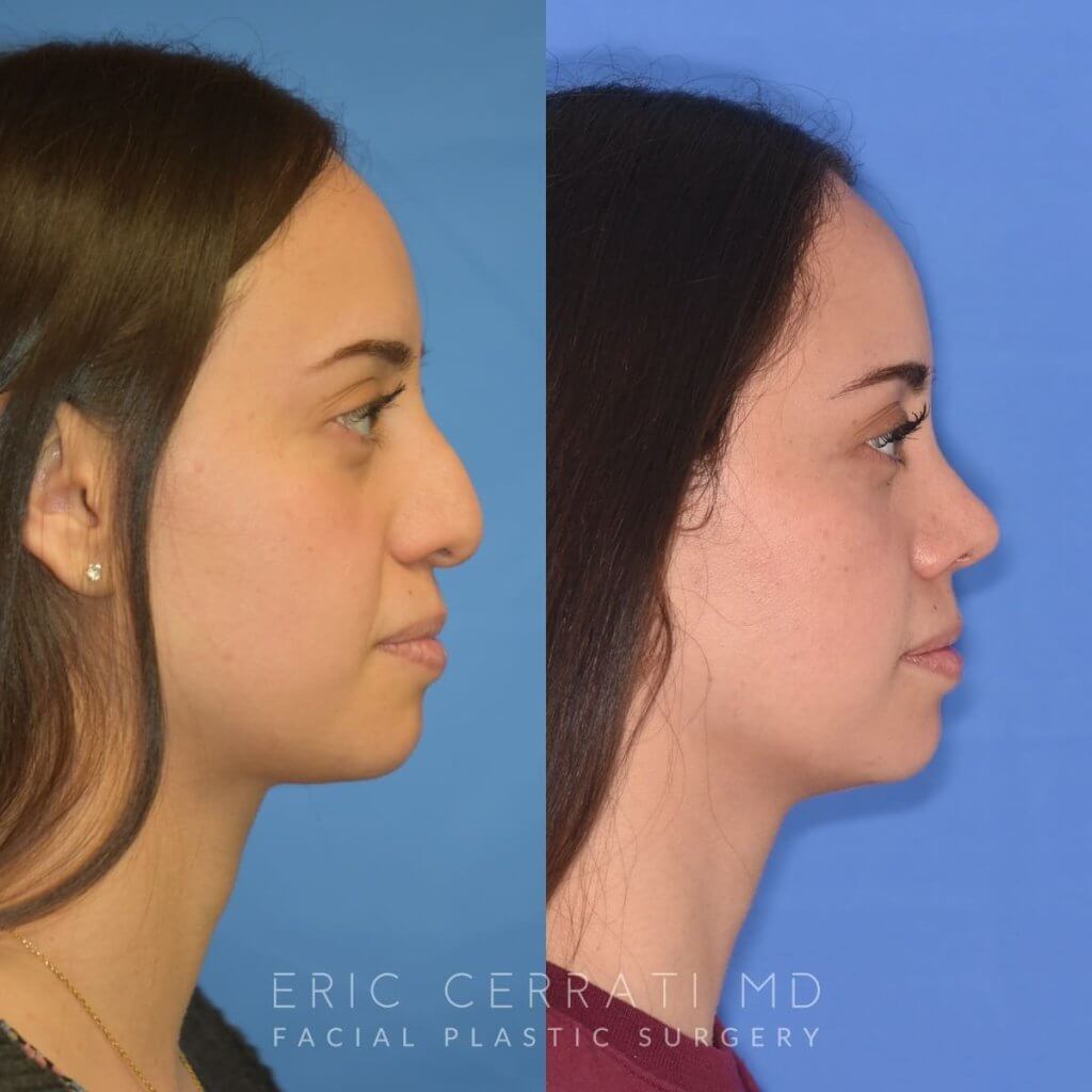 Female patient before and after rhinoplasty