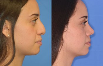 Female patient before and after rhinoplasty