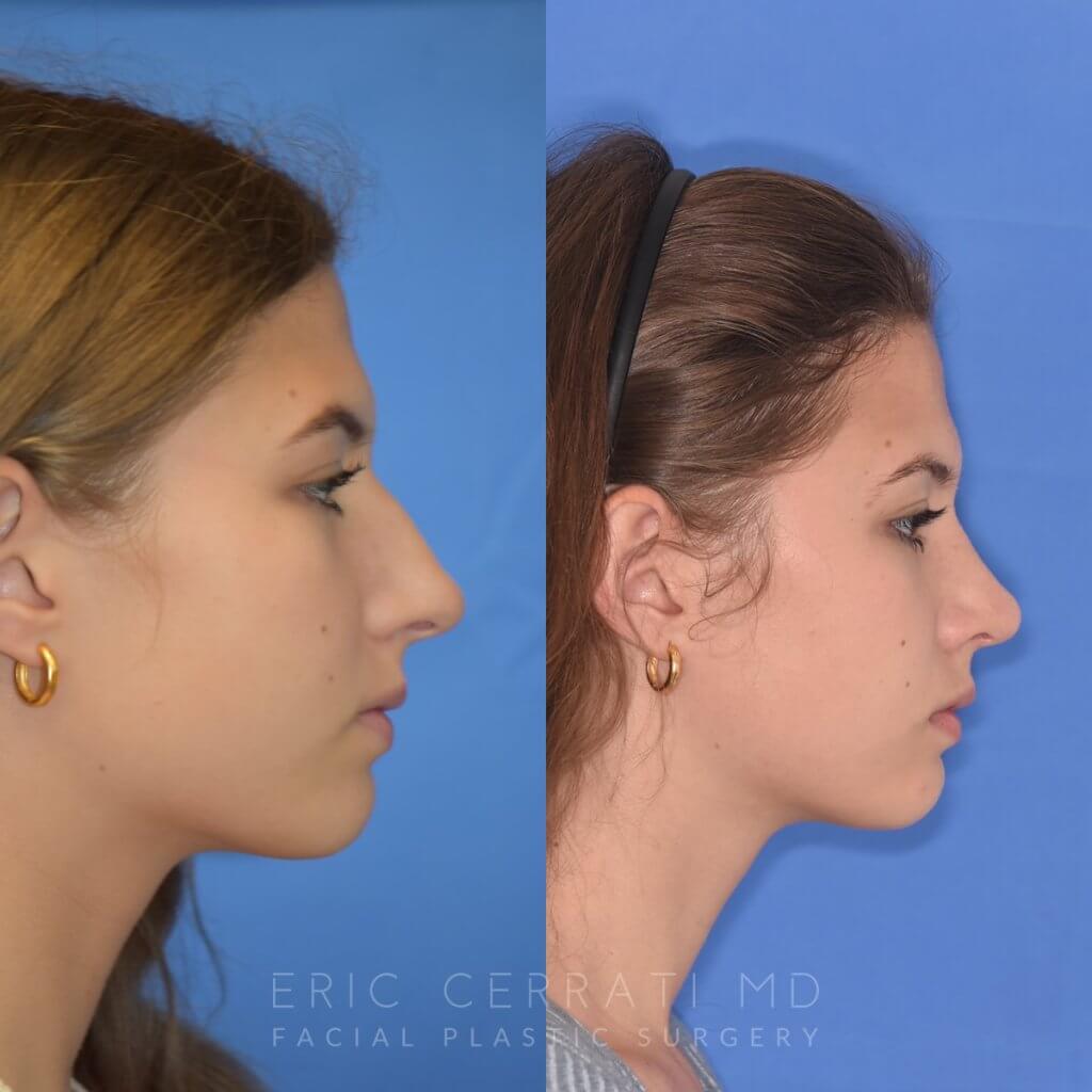 Female patient before and after rhinoplasty