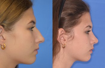 Female patient before and after rhinoplasty