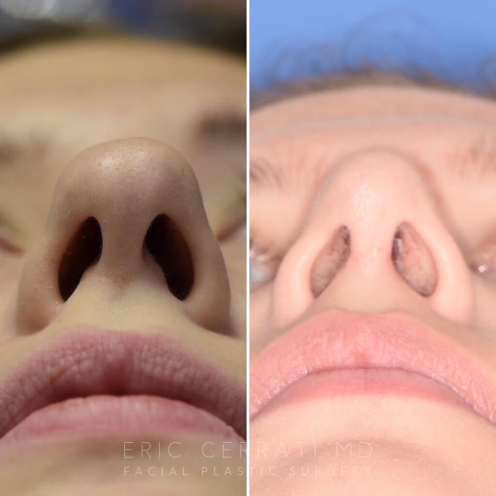 Female patient before and after rhinoplasty