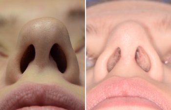 Female patient before and after rhinoplasty