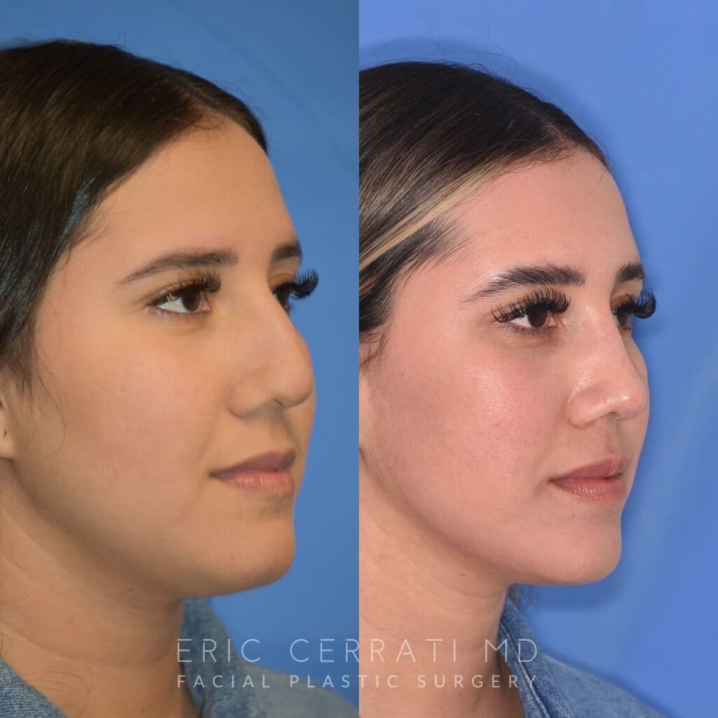 Female patient before and after rhinoplasty
