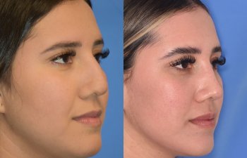 Female patient before and after rhinoplasty