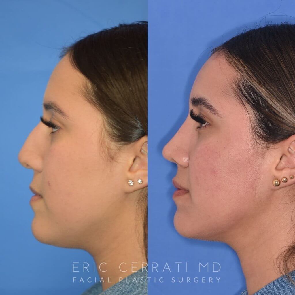 Female patient before and after rhinoplasty