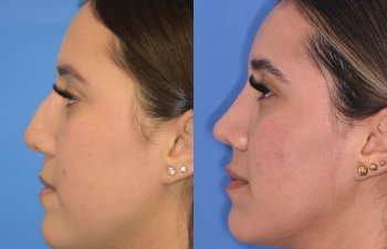 Female patient before and after rhinoplasty