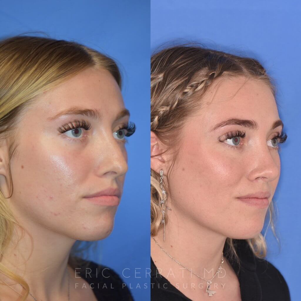 Female patient before and after rhinoplasty
