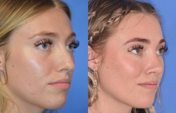 Female patient before and after rhinoplasty