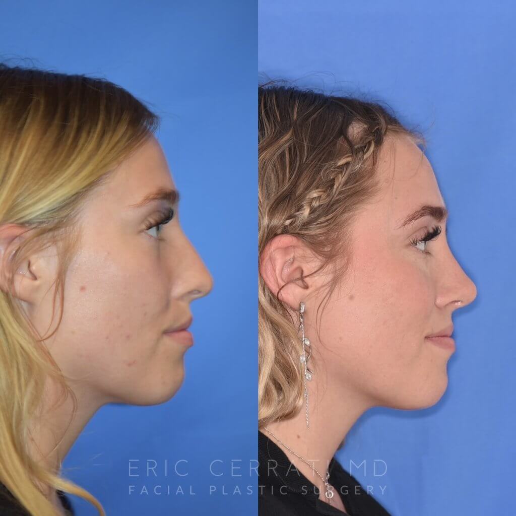 Female patient before and after rhinoplasty