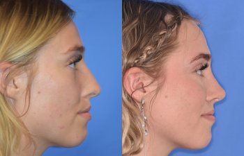 Female patient before and after rhinoplasty