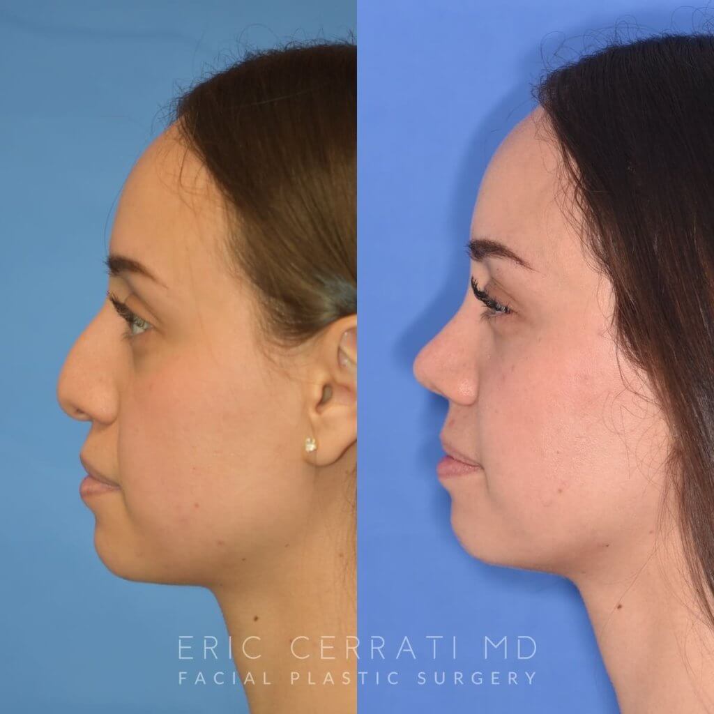 Female patient before and after rhinoplasty