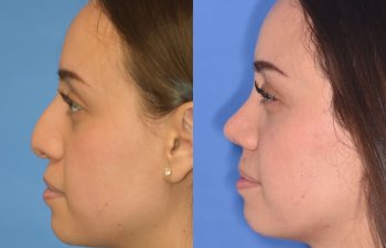 Female patient before and after rhinoplasty