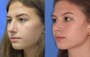 Female patient before and after rhinoplasty