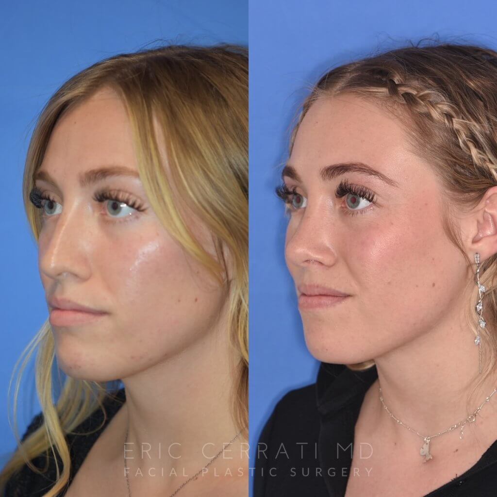 Female patient before and after rhinoplasty