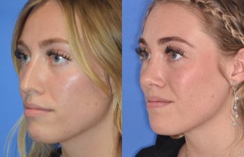 Female patient before and after rhinoplasty