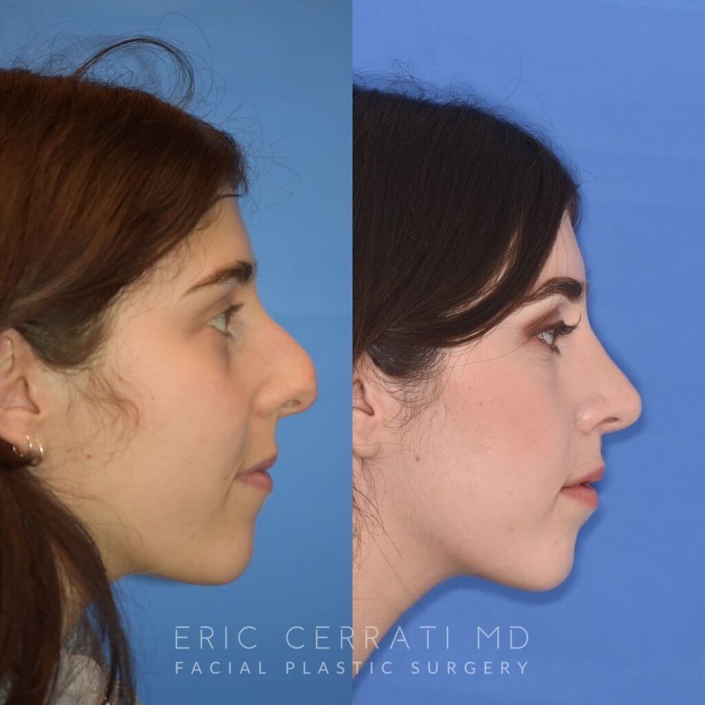 Female patient before and after rhinoplasty