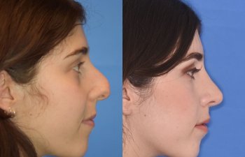 Female patient before and after rhinoplasty