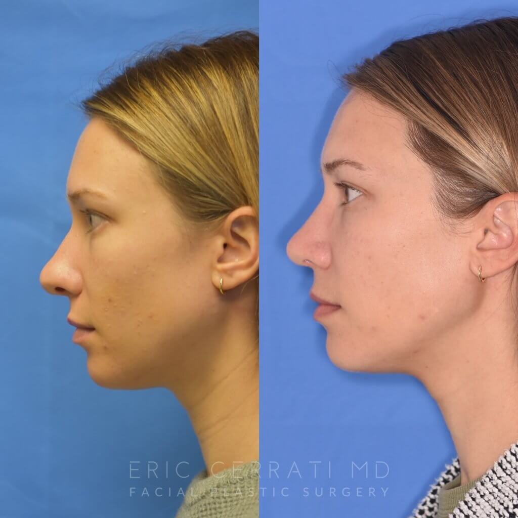 Female patient before and after rhinoplasty