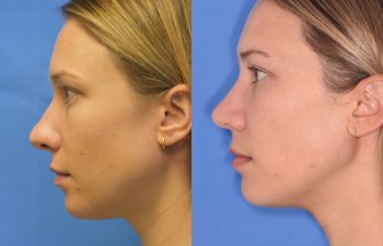 Female patient before and after rhinoplasty