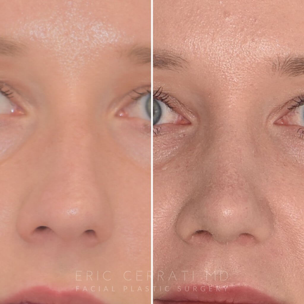 Female patient before and after rhinoplasty