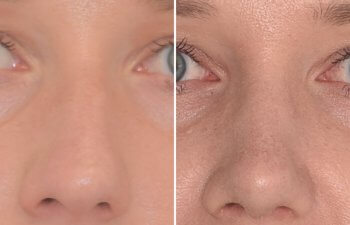Female patient before and after rhinoplasty