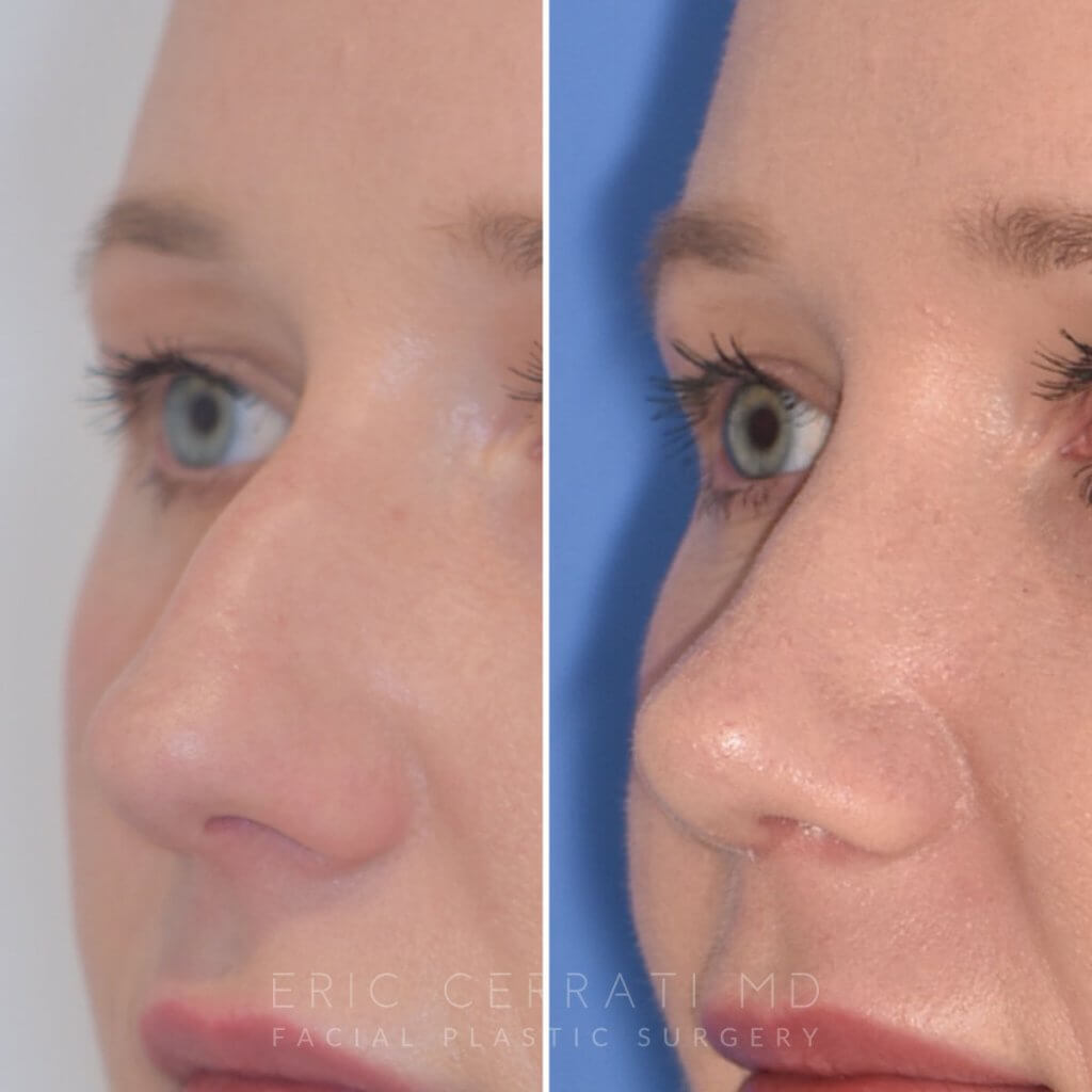 Female patient before and after rhinoplasty
