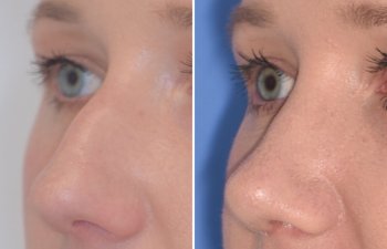 Female patient before and after rhinoplasty