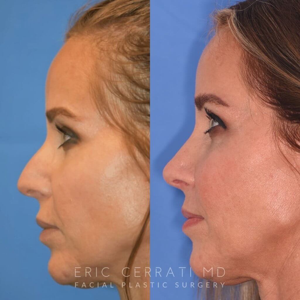Female patient before and after rhinoplasty