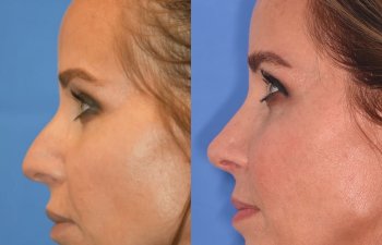 Female patient before and after rhinoplasty