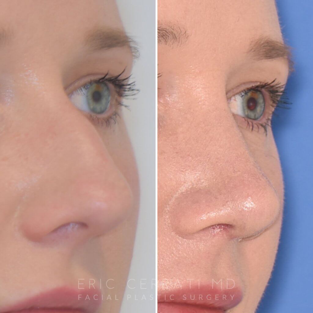 Female patient before and after rhinoplasty