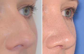 Female patient before and after rhinoplasty