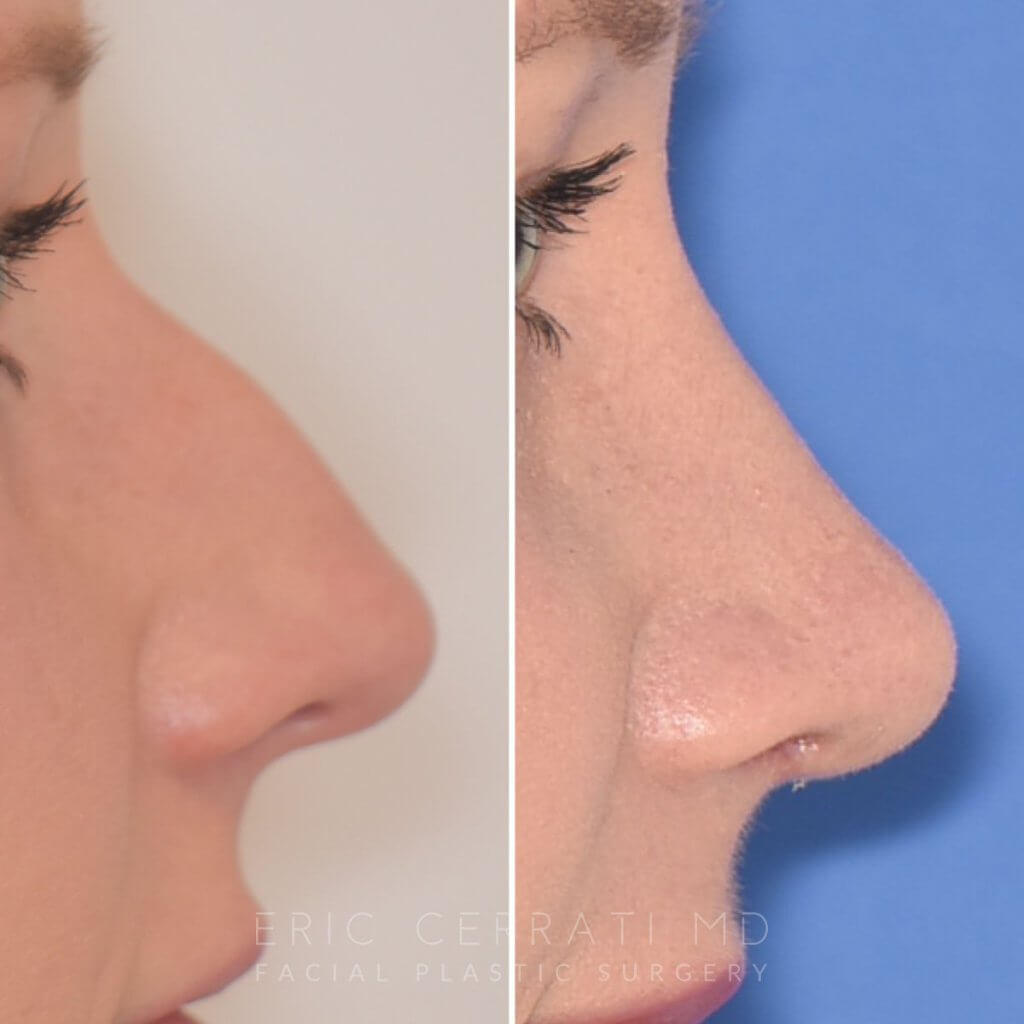 Female patient before and after rhinoplasty
