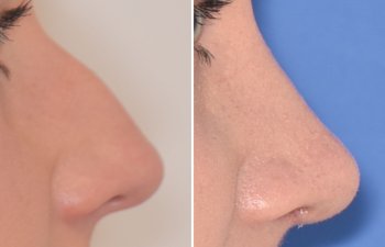 Female patient before and after rhinoplasty