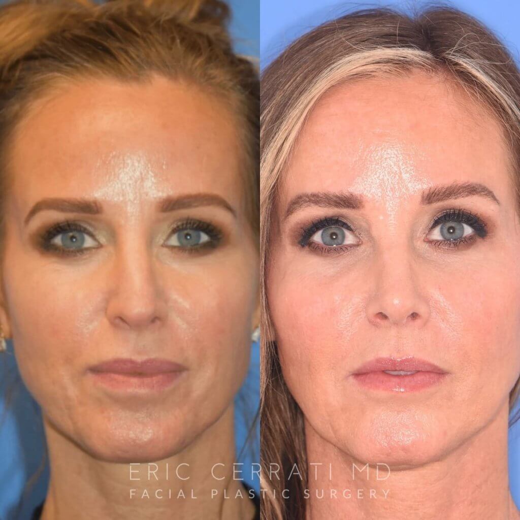Female patient before and after rhinoplasty