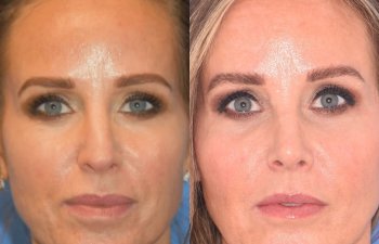 Female patient before and after rhinoplasty