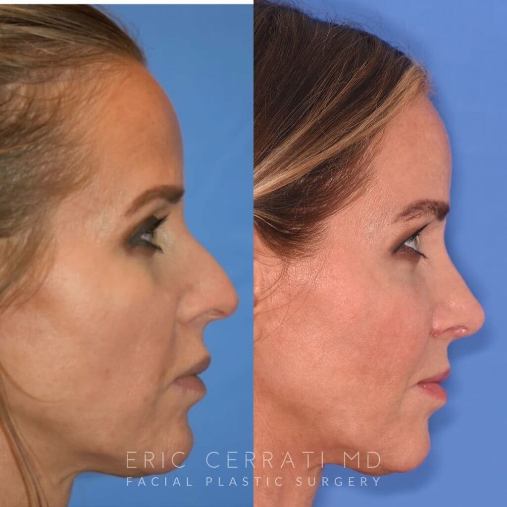 Female patient before and after rhinoplasty