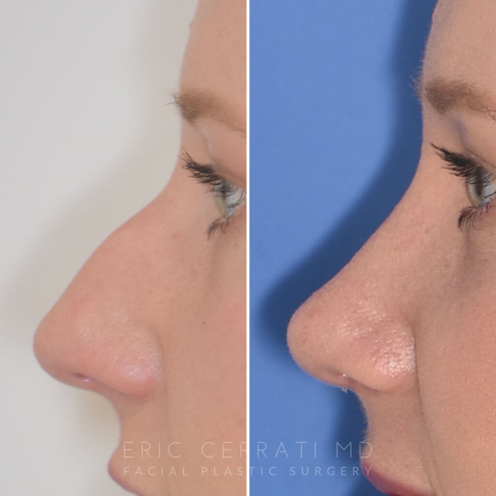 Female patient before and after rhinoplasty
