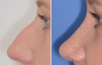 Female patient before and after rhinoplasty