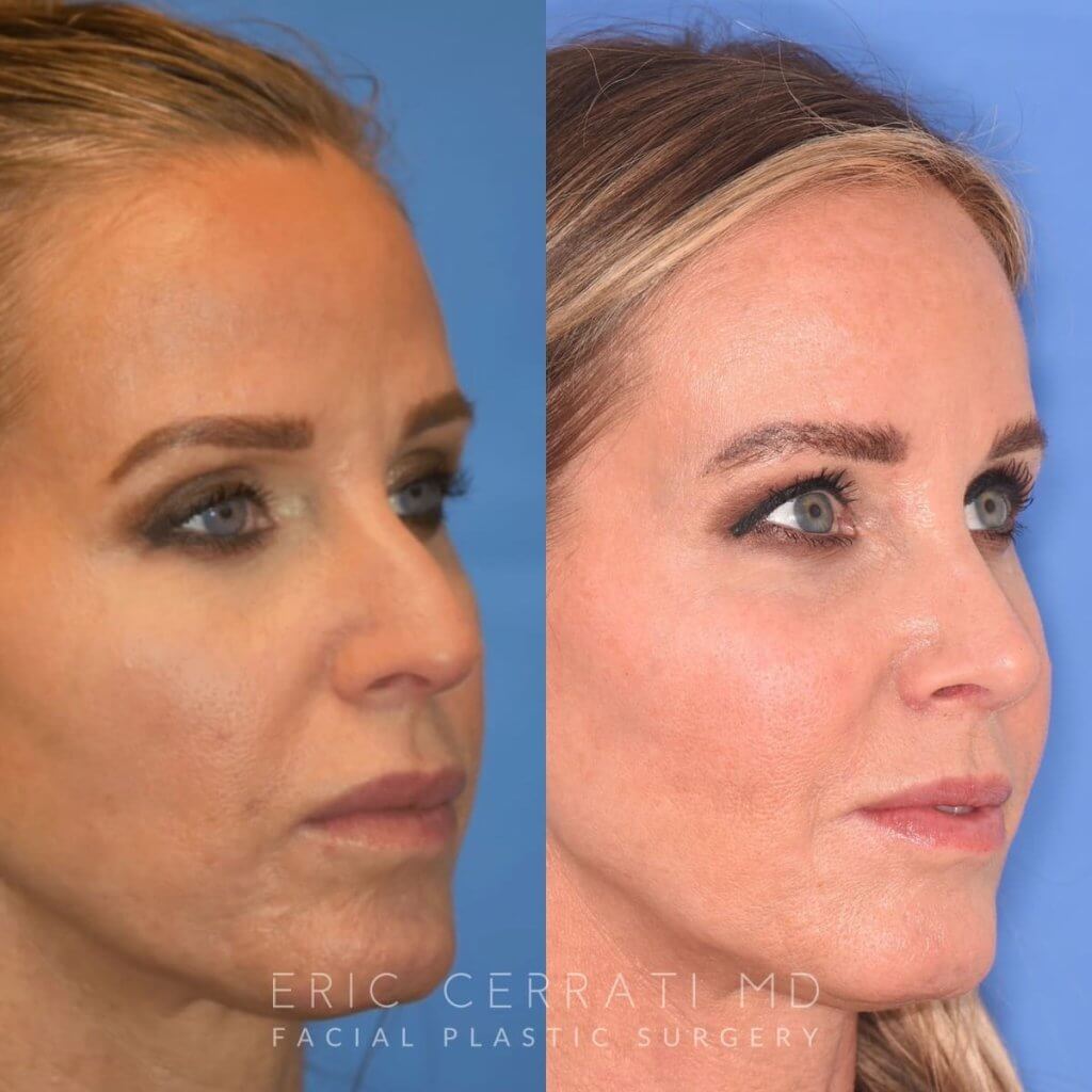 Female patient before and after rhinoplasty