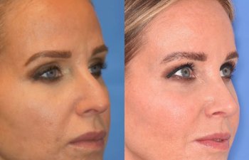 Female patient before and after rhinoplasty