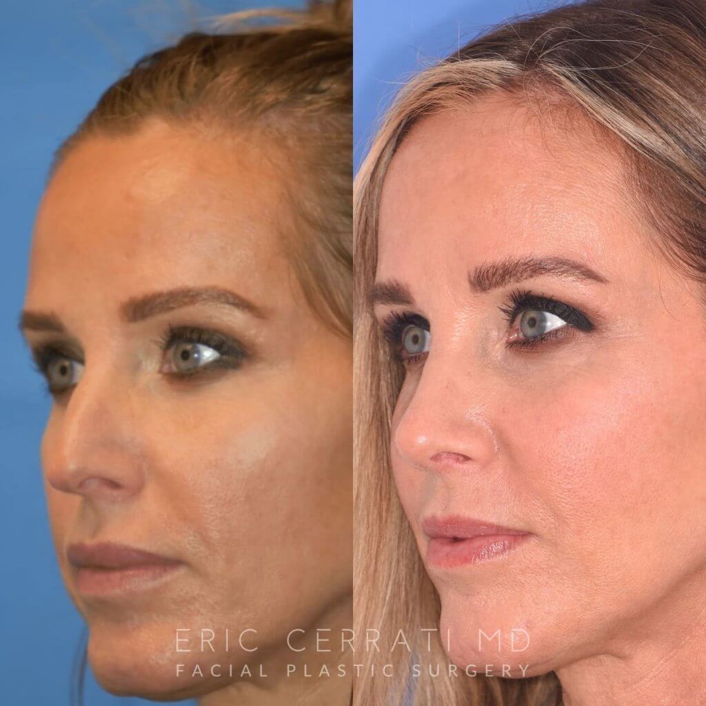 Female patient before and after rhinoplasty
