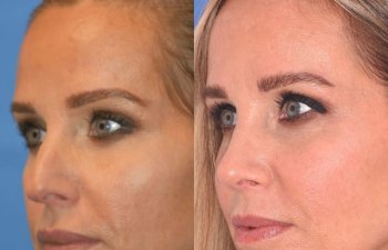 Female patient before and after rhinoplasty