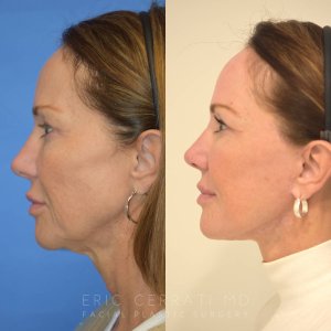 patient before and after facelift procedure