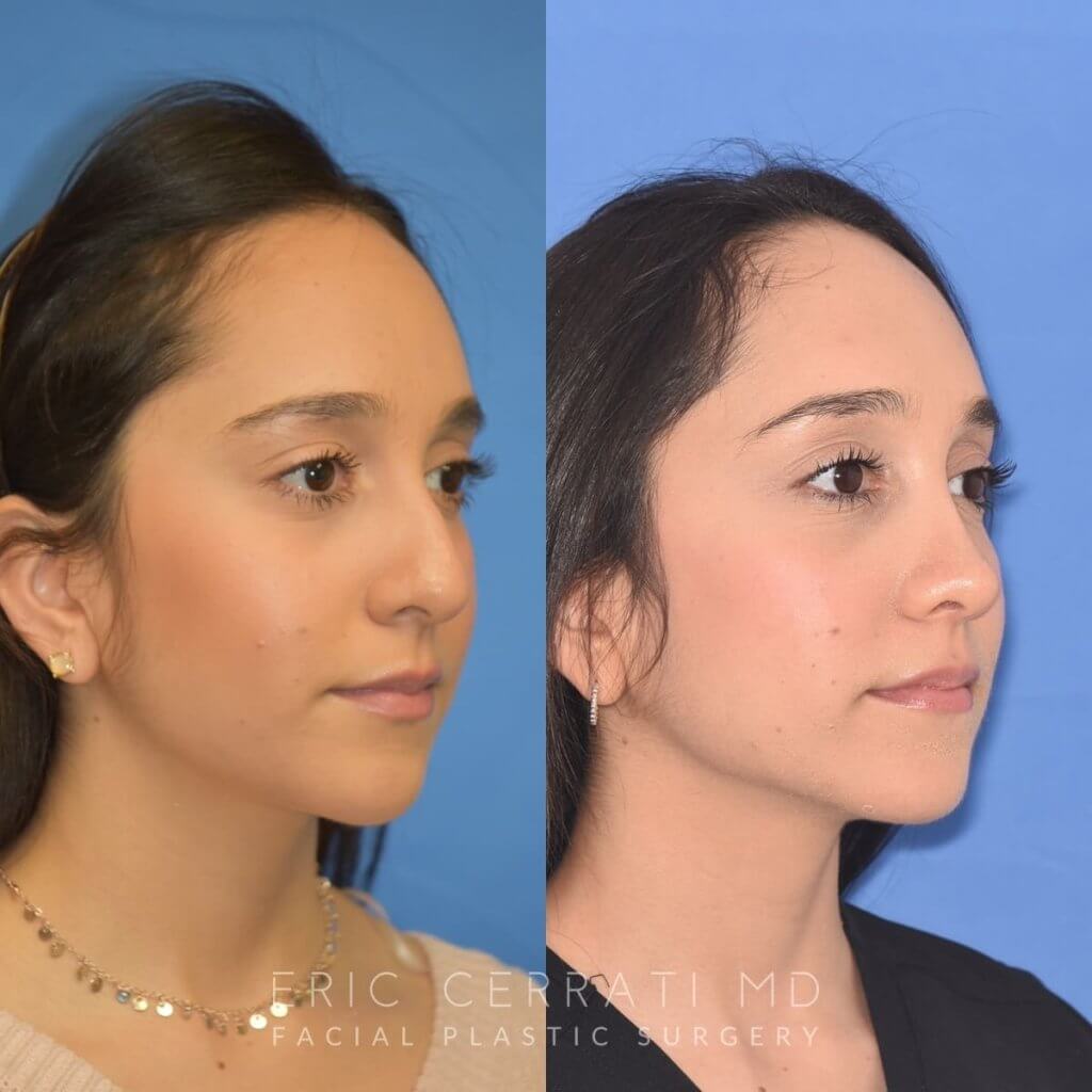 patient before and after rhinoplasty