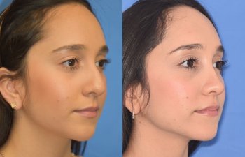patient before and after rhinoplasty
