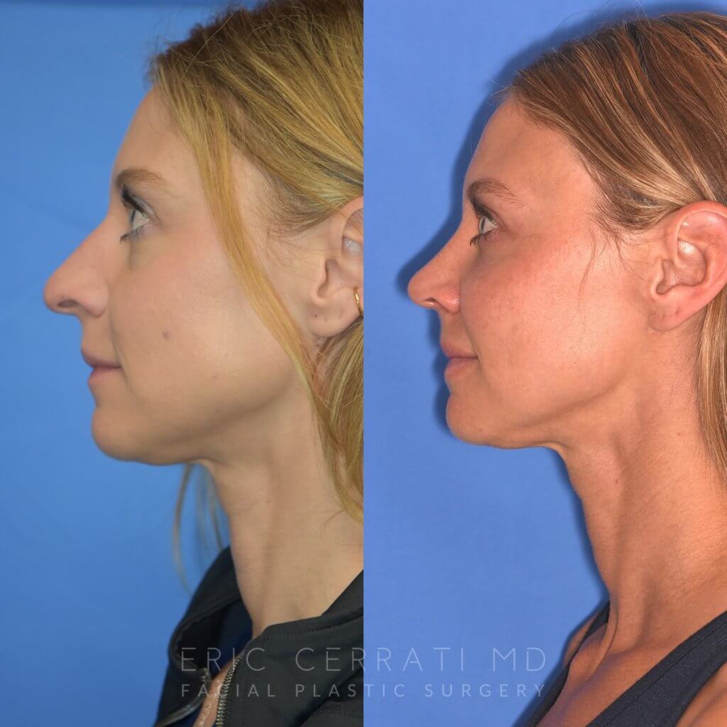Female patient before and after rhinoplasty