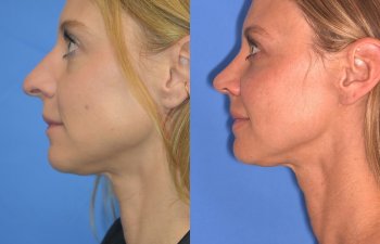 Female patient before and after rhinoplasty