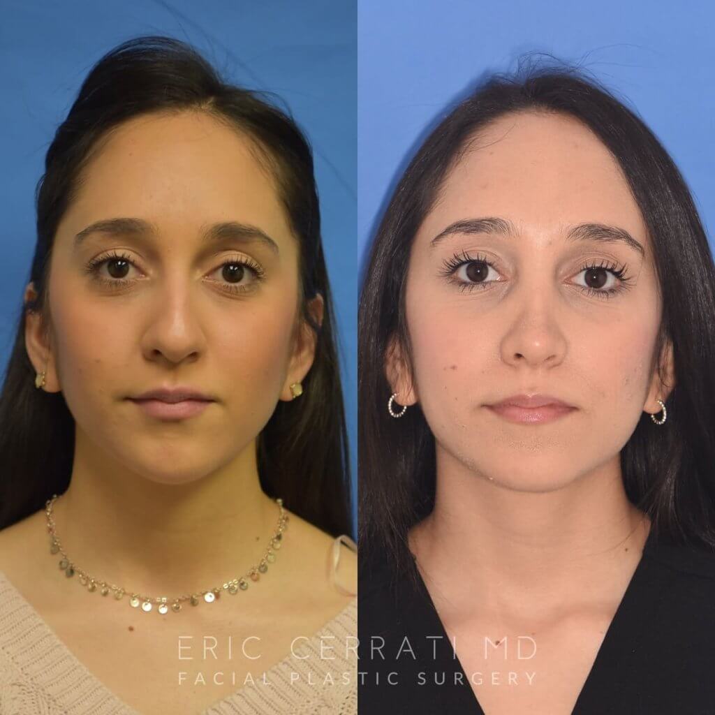 patient before and after rhinoplasty